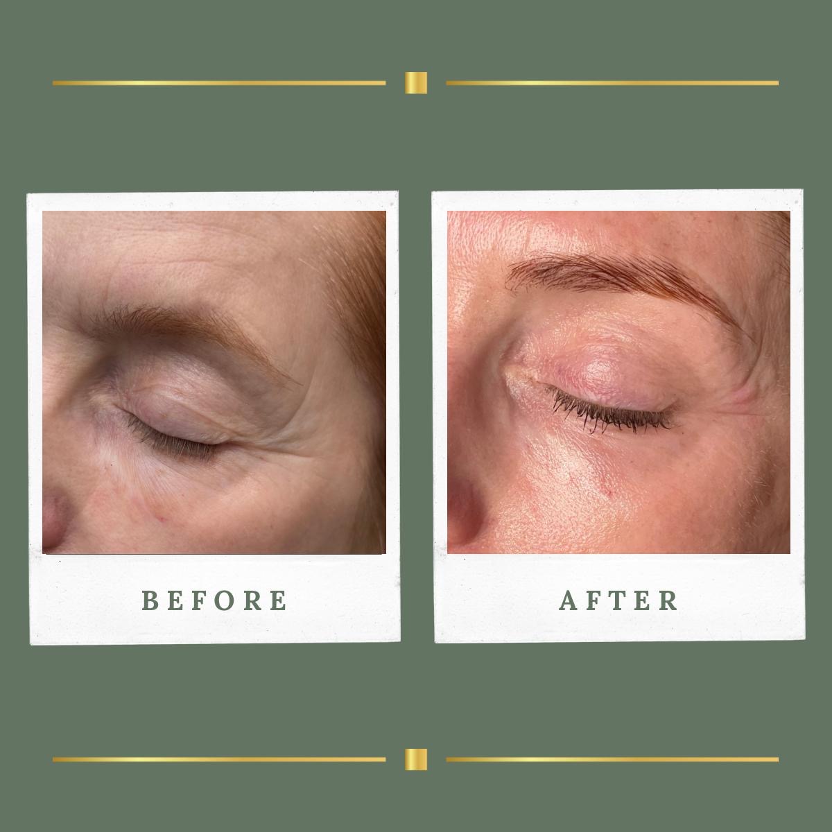 Before and after plasma upper eyelid tightening result at Rachel Aesthetics