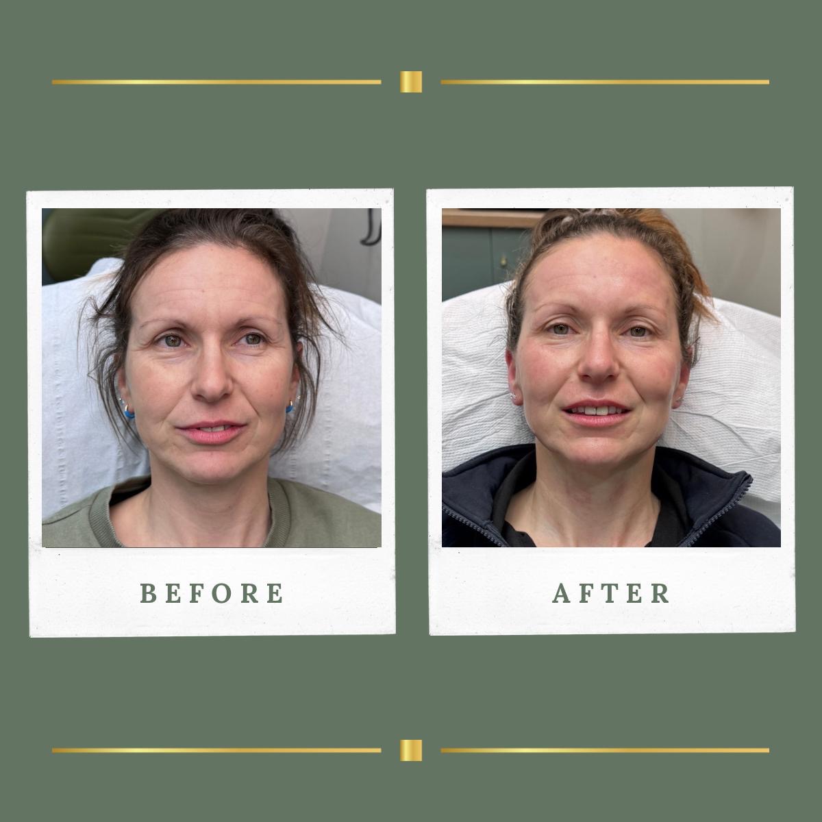 Front view before and after microneedling result at Rachel Aesthetics
