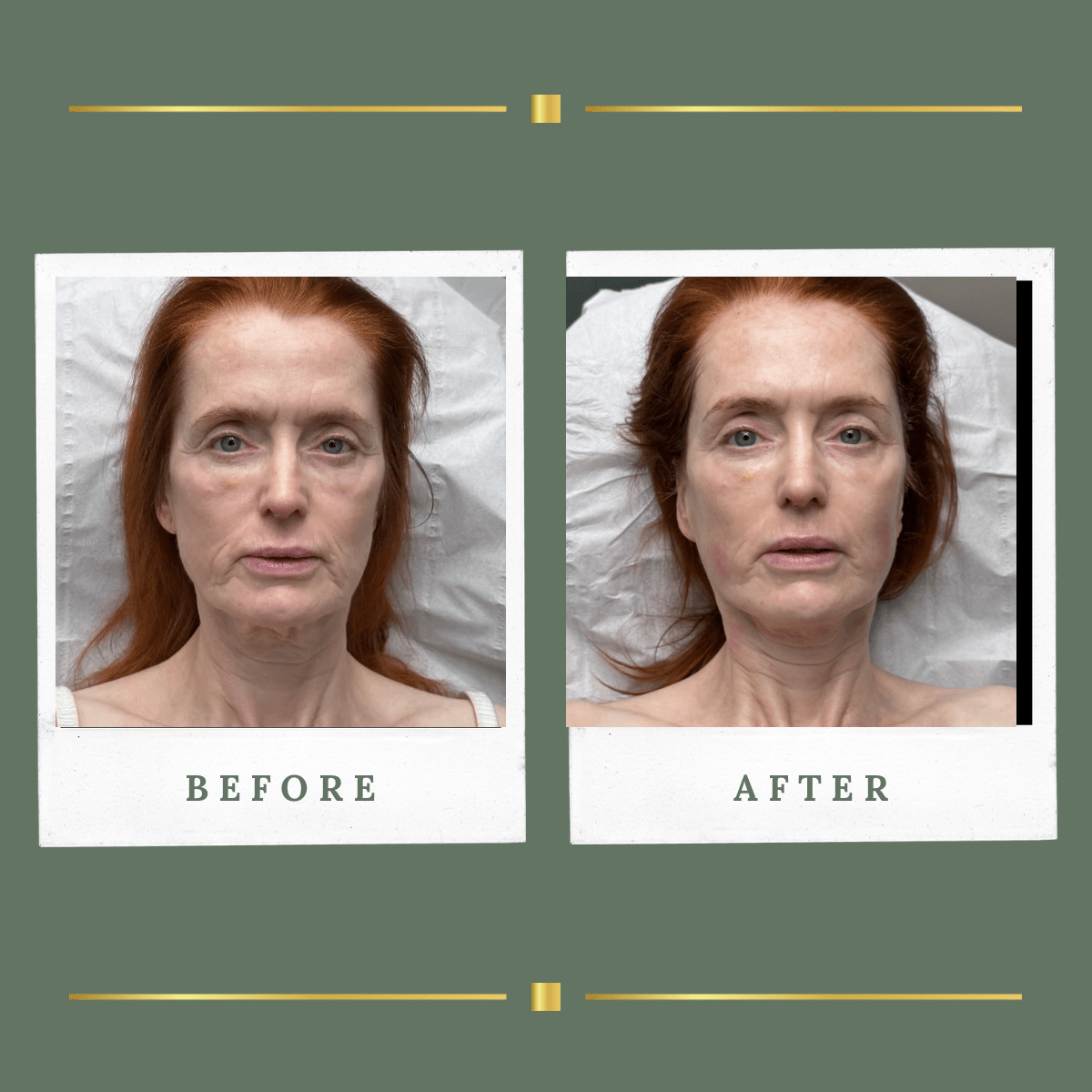 Non surgical HIFU facelift before and after result, Nottinghamshire