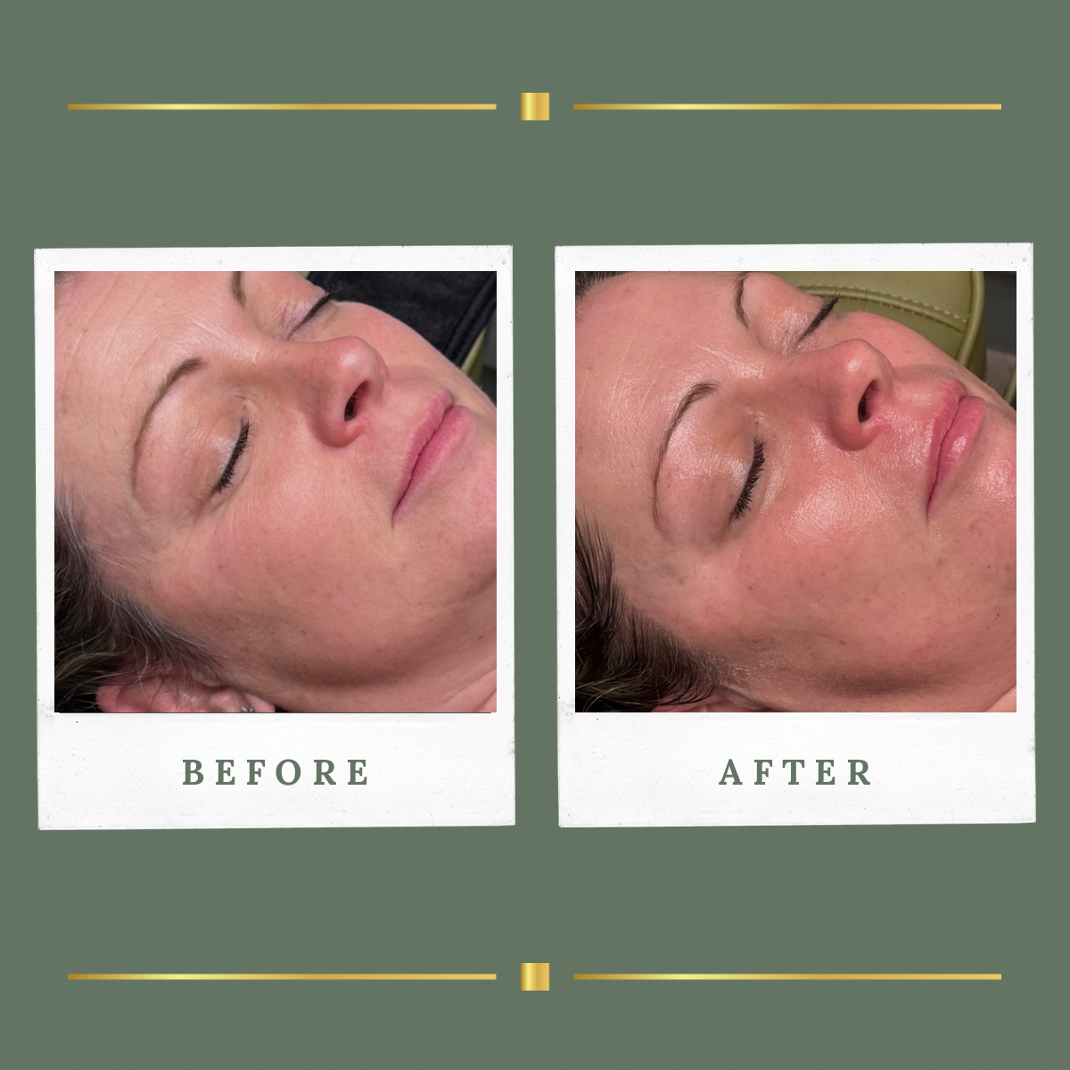 Before and after glass skin facial result for a client from Mansfield