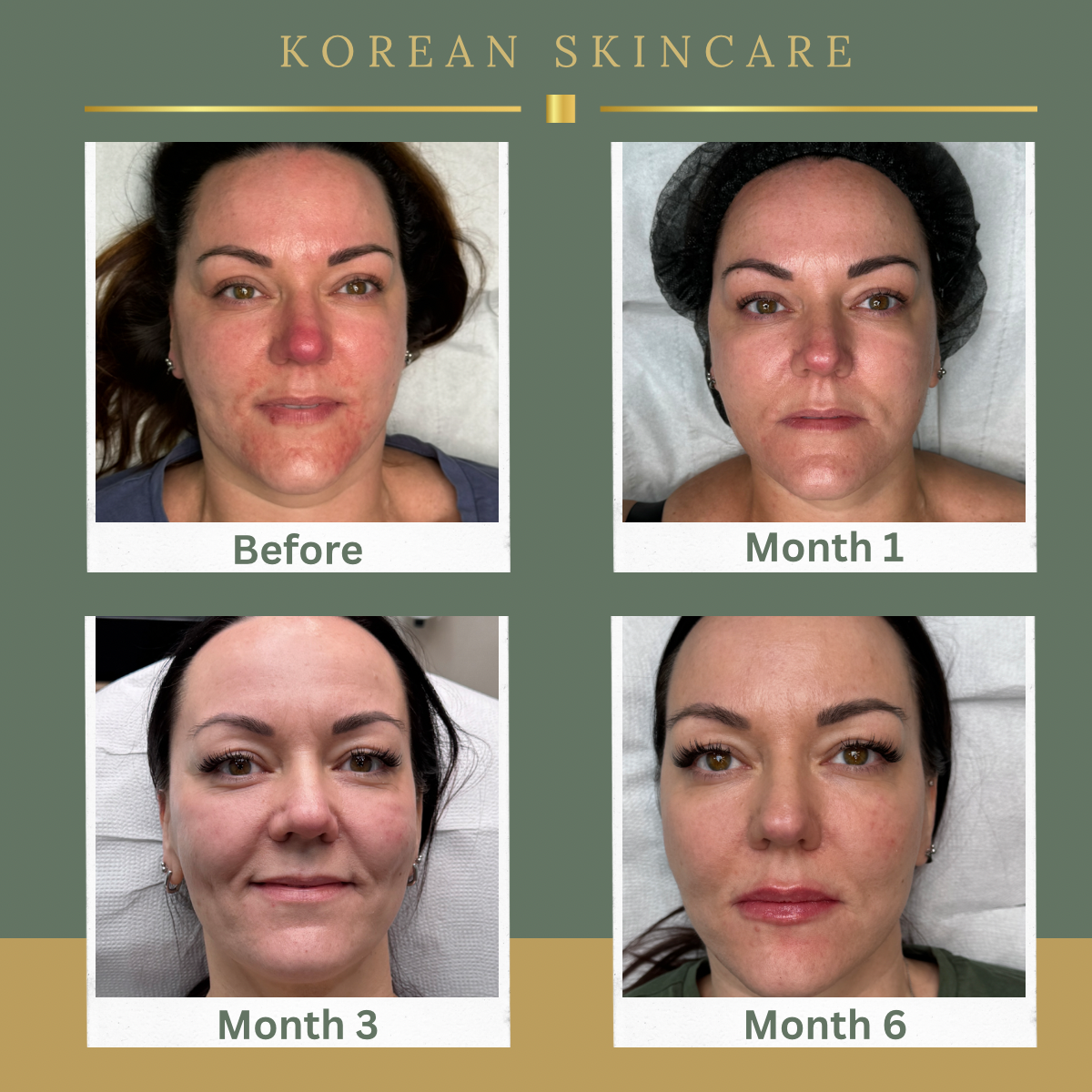 Six month Korean skincare transformation for rosacea-prone skin at Rachel Aesthetics