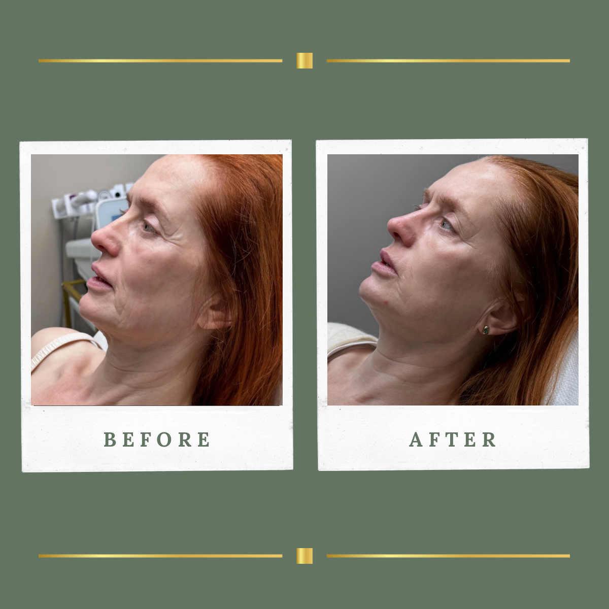 Chemical peel before and after result at Rachel Aesthetics, Nottinghamshire