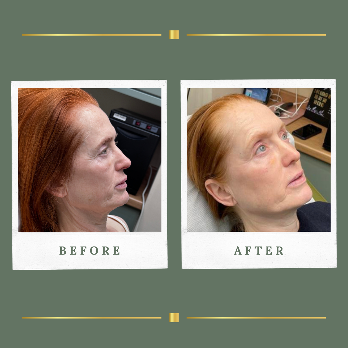 Profile before and after skin transformation result at Rachel Aesthetics, Farnsfield