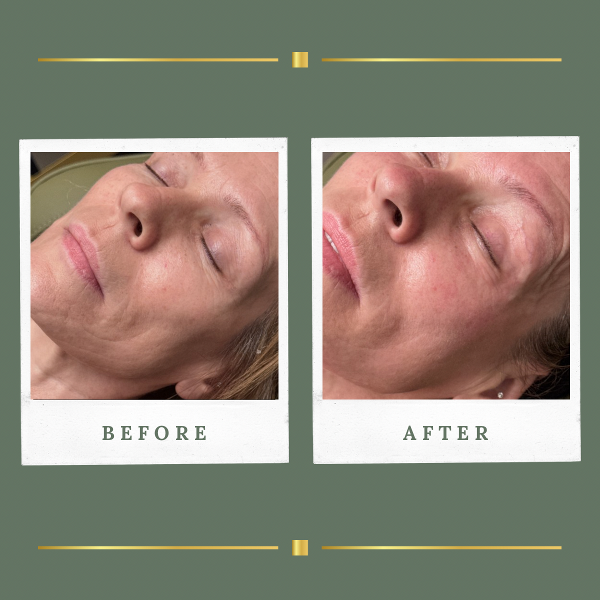 Before and after Korean facial result in Nottinghamshire