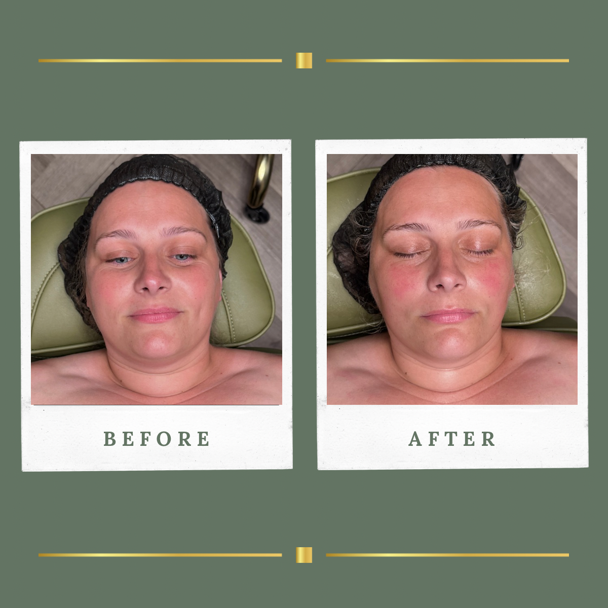 Before and after facial treatment result in Nottinghamshire