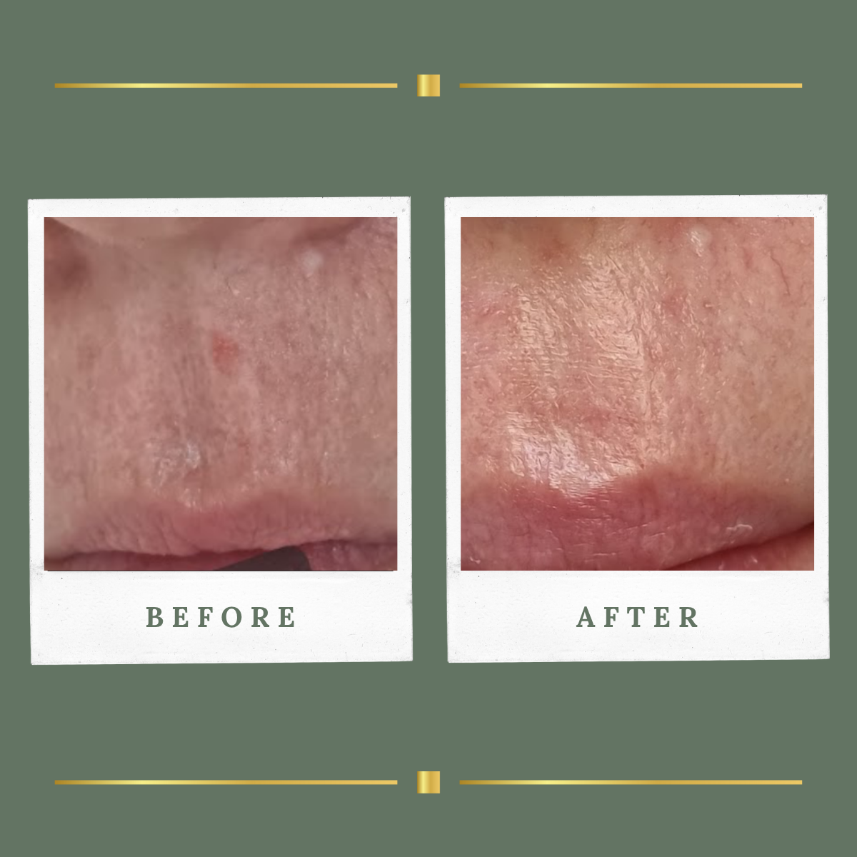 Before and after plasma skin tag removal result for a client from Nottingham