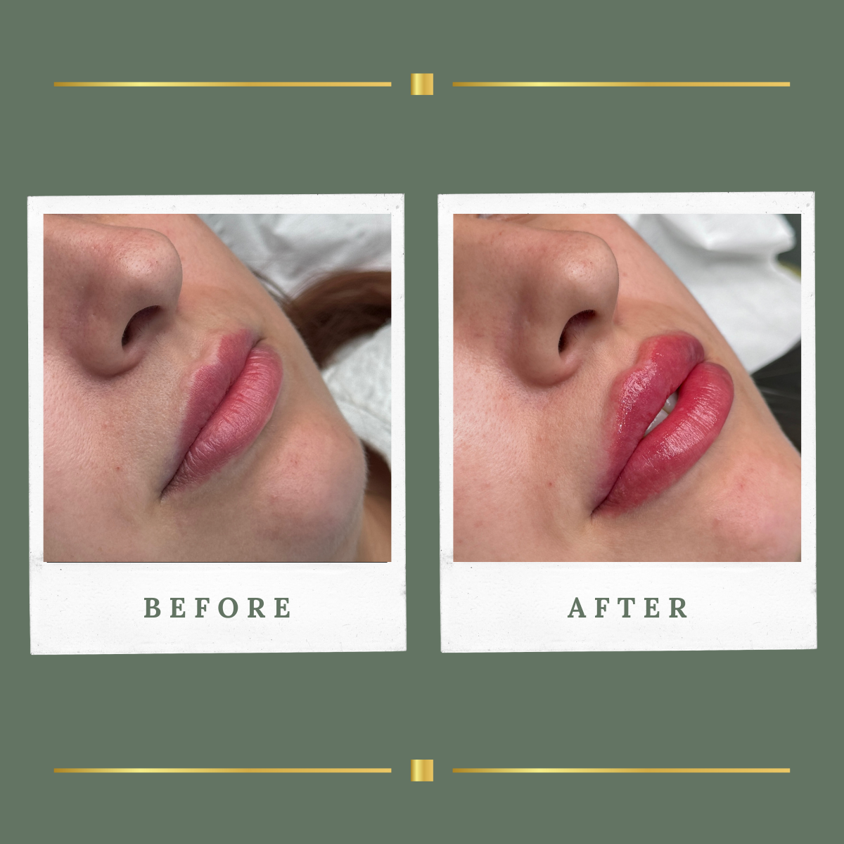 Lip filler before and after result for a client from Mansfield