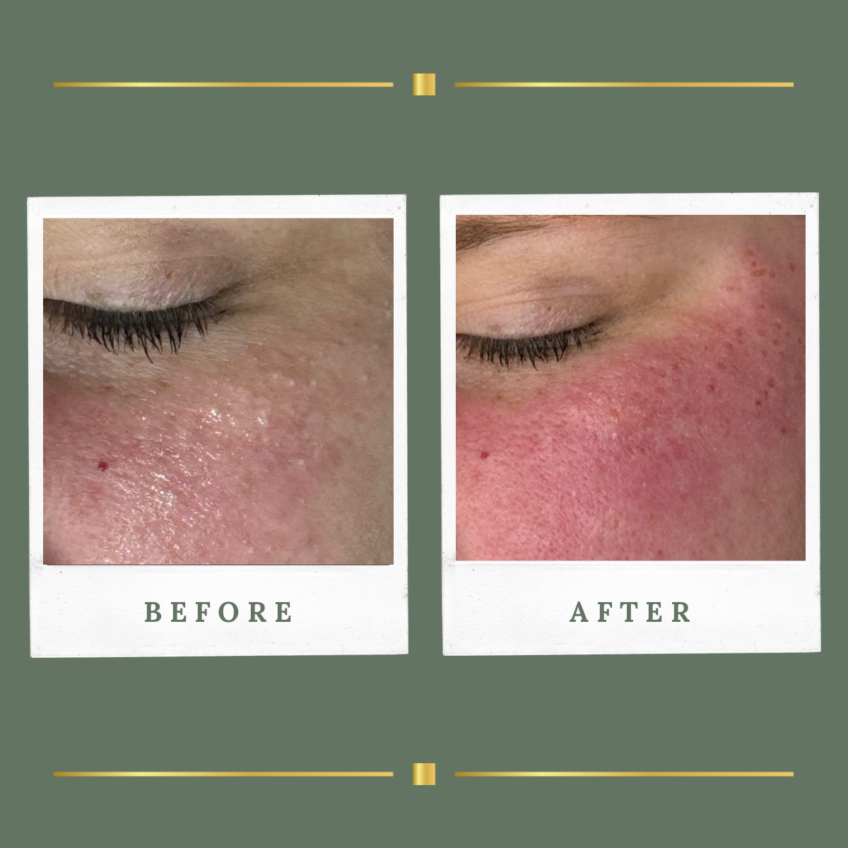 Before and after plasma milia removal result for a client from Mansfield