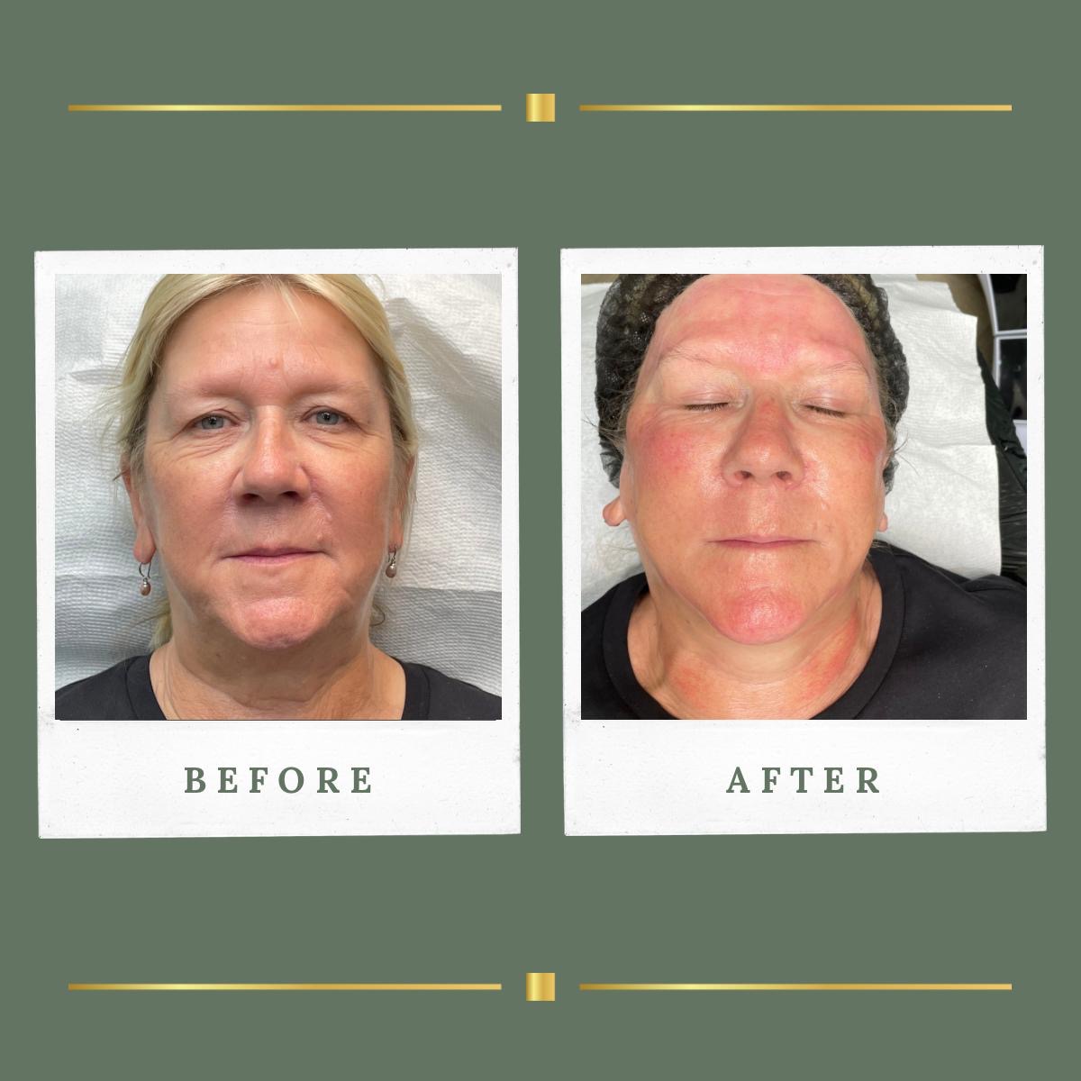 Front view before and after skin needling result at Rachel Aesthetics, Farnsfield