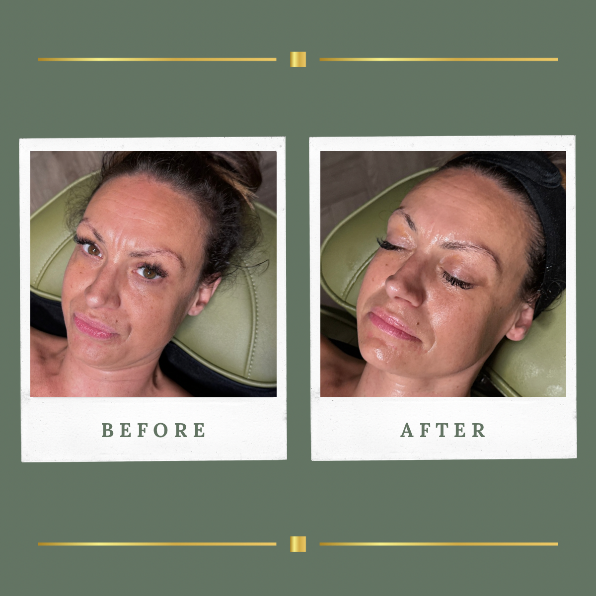 Before and after facial skin rejuvenation result at Rachel Aesthetics