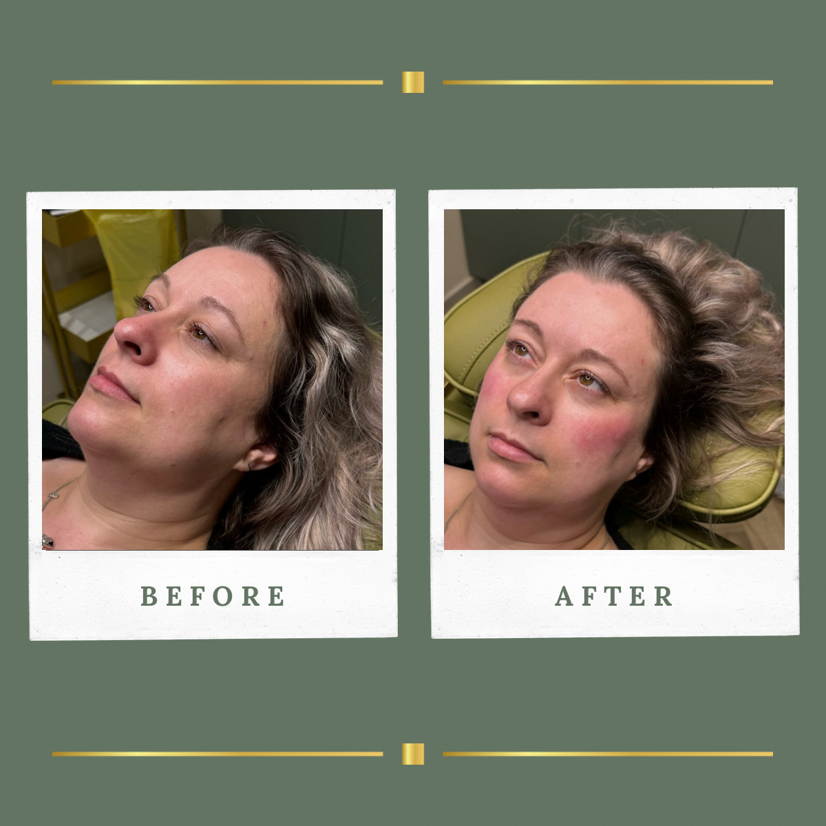 Cheek filler before and after result for a client from Nottingham