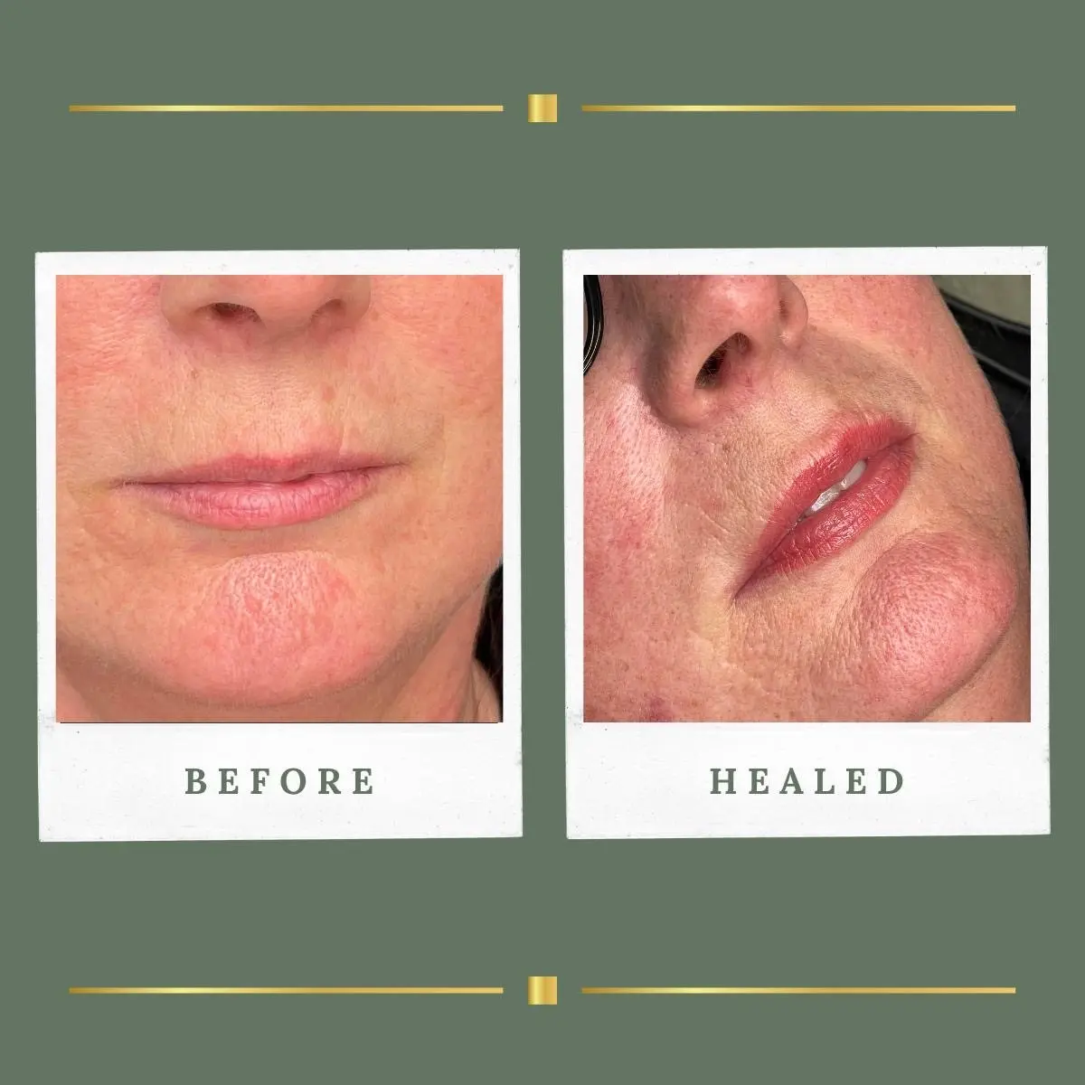 Healed lip blush restoring natural pink tone, Rachel Aesthetics