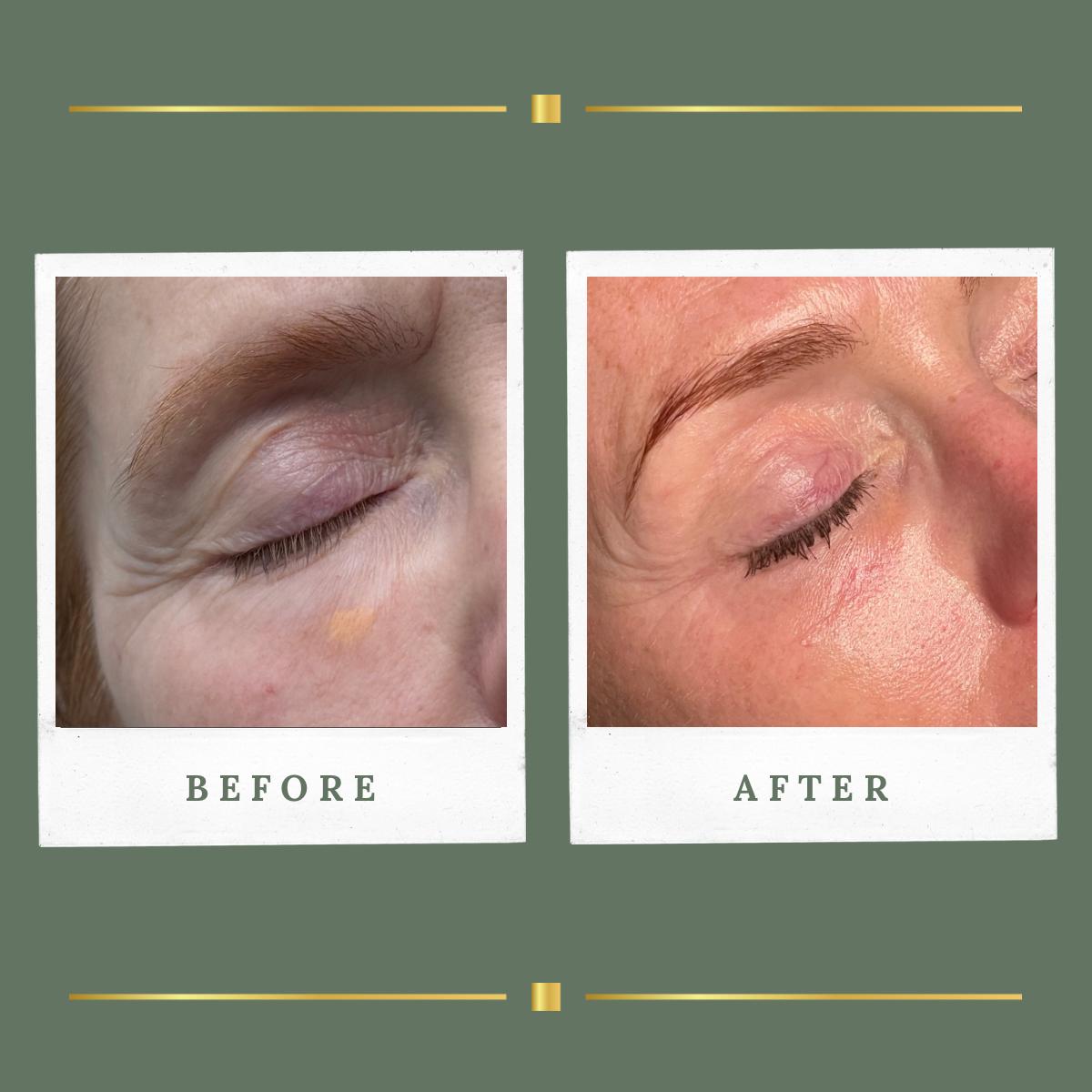 Before and after plasma eye tightening result at Rachel Aesthetics