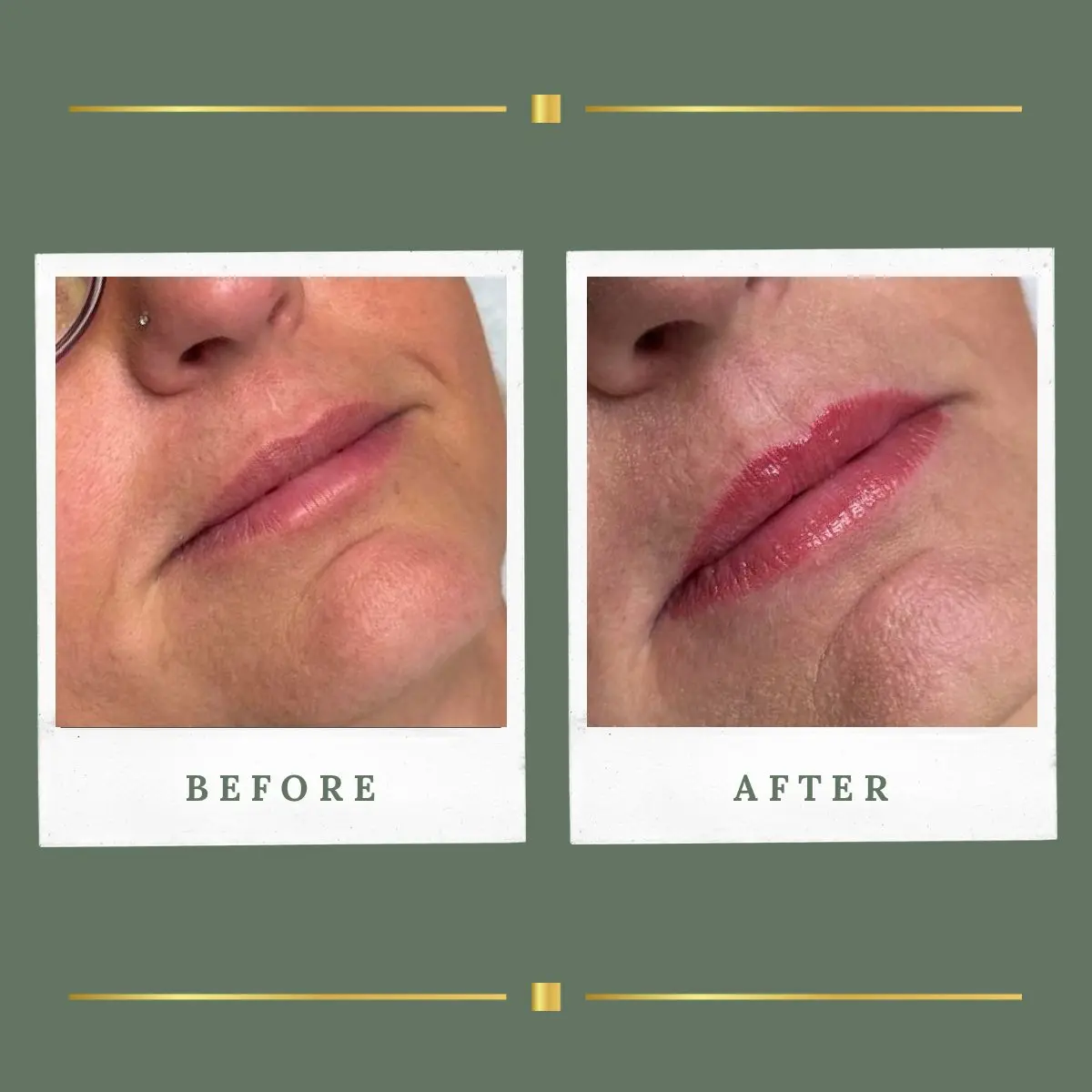 Healed lip blush result, Rachel Aesthetics Farnsfield