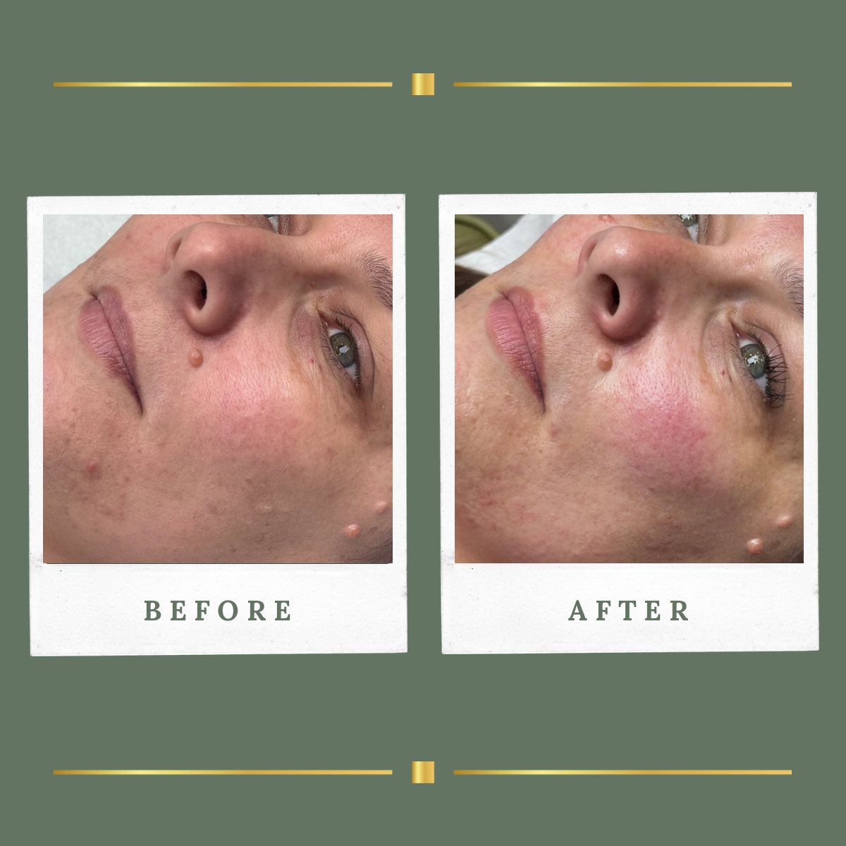 Radio frequency microneedling treatment result, Nottinghamshire