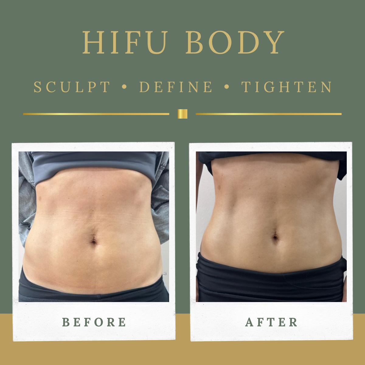Front view before and after HIFU body sculpting treatment