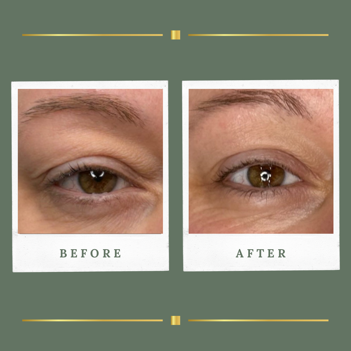 Before and after plasma eyelid reduction result for a client from Nottingham