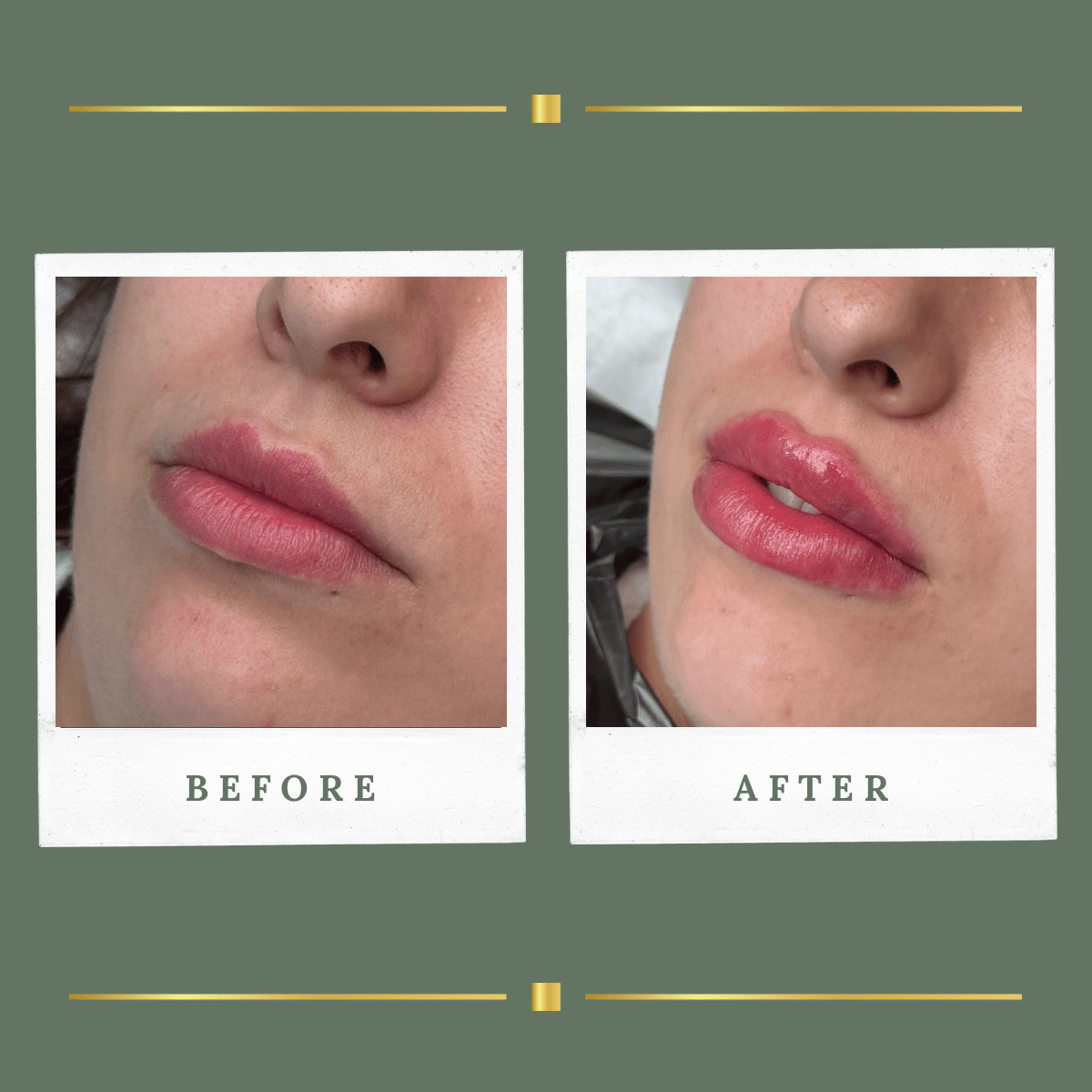 Lip filler treatment before and after result, Nottinghamshire