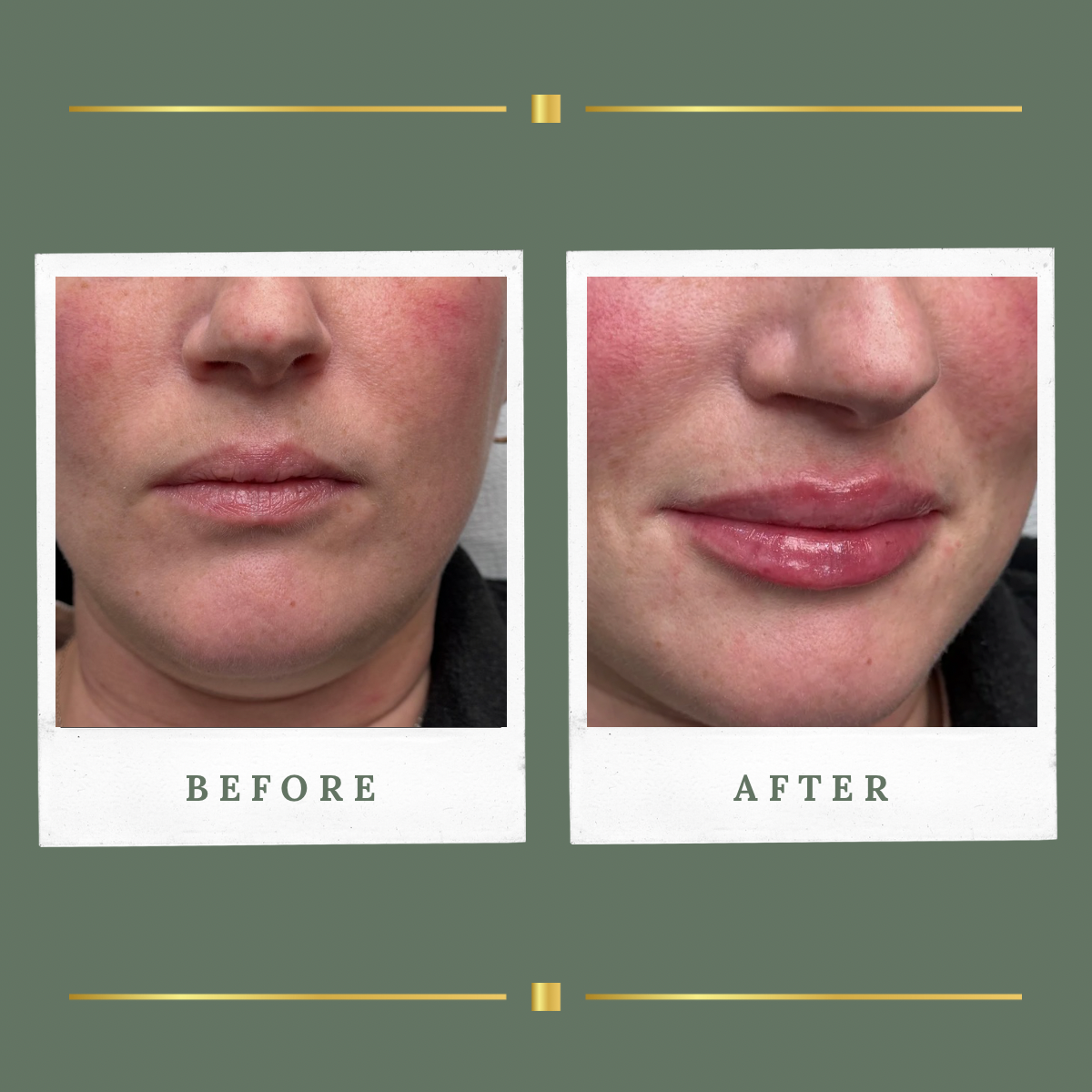 Lip filler before and after result for a client from Newark