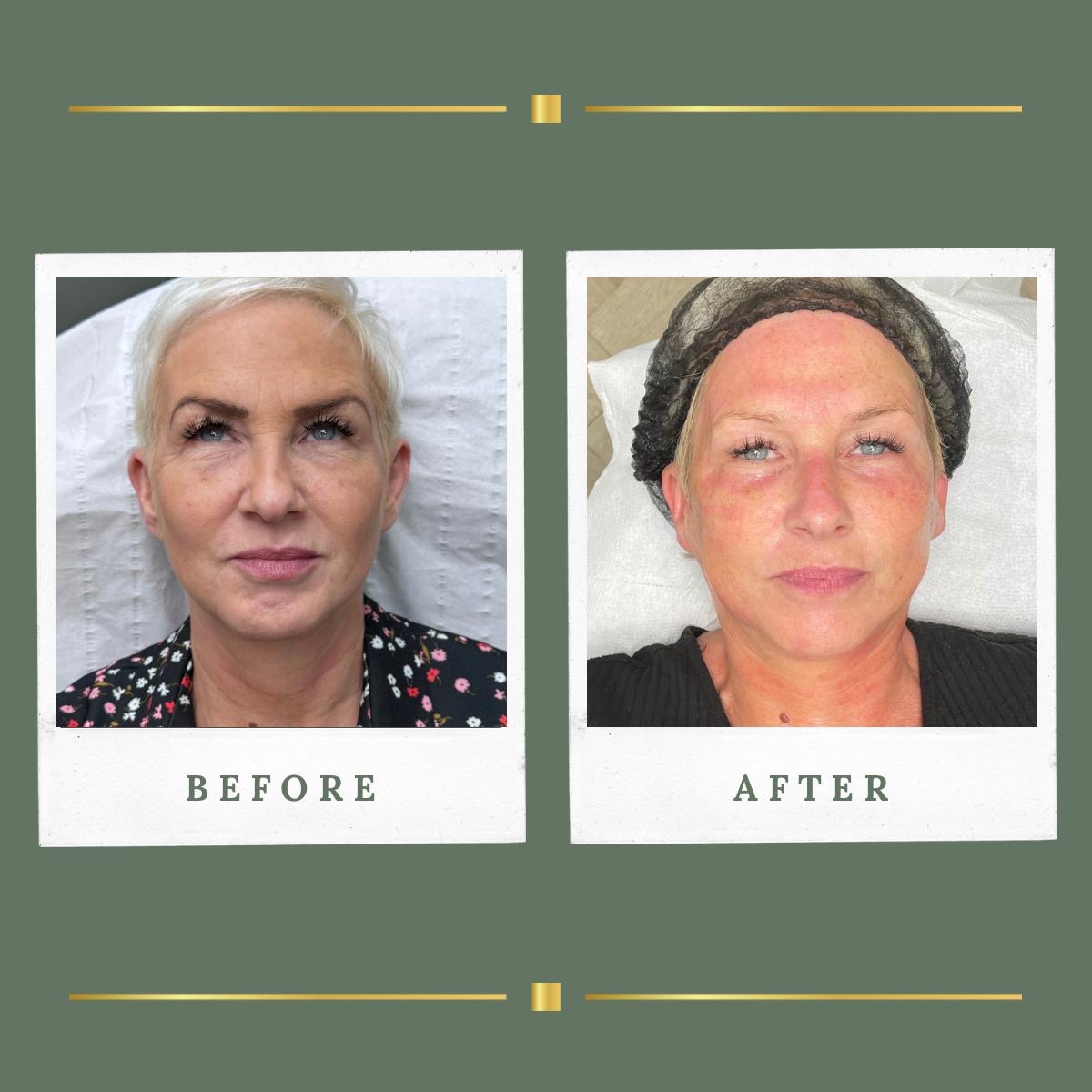 Before and after skin needling result for a client at Rachel Aesthetics, Nottinghamshire