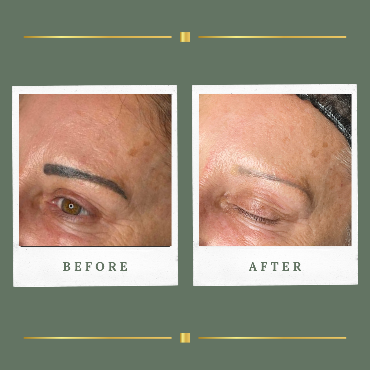 Eyebrow cosmetic tattoo removal before and after result at Rachel Aesthetics, Farnsfield