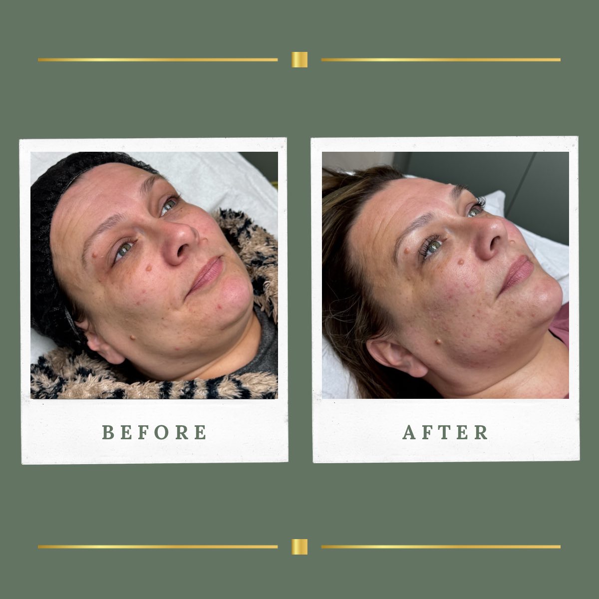 Radio frequency microneedling skin result at Rachel Aesthetics