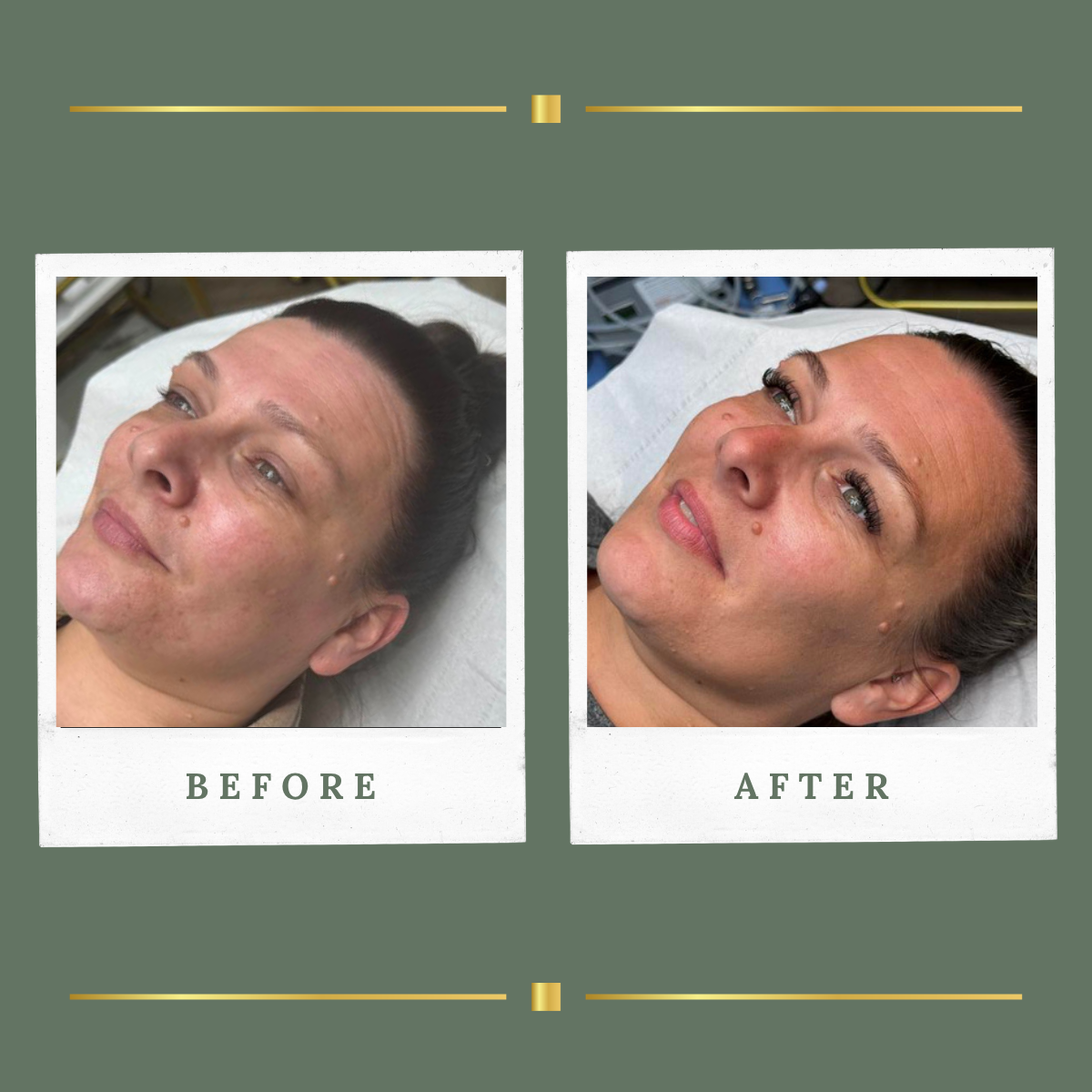 Before and after skin transformation result at Rachel Aesthetics, Nottinghamshire