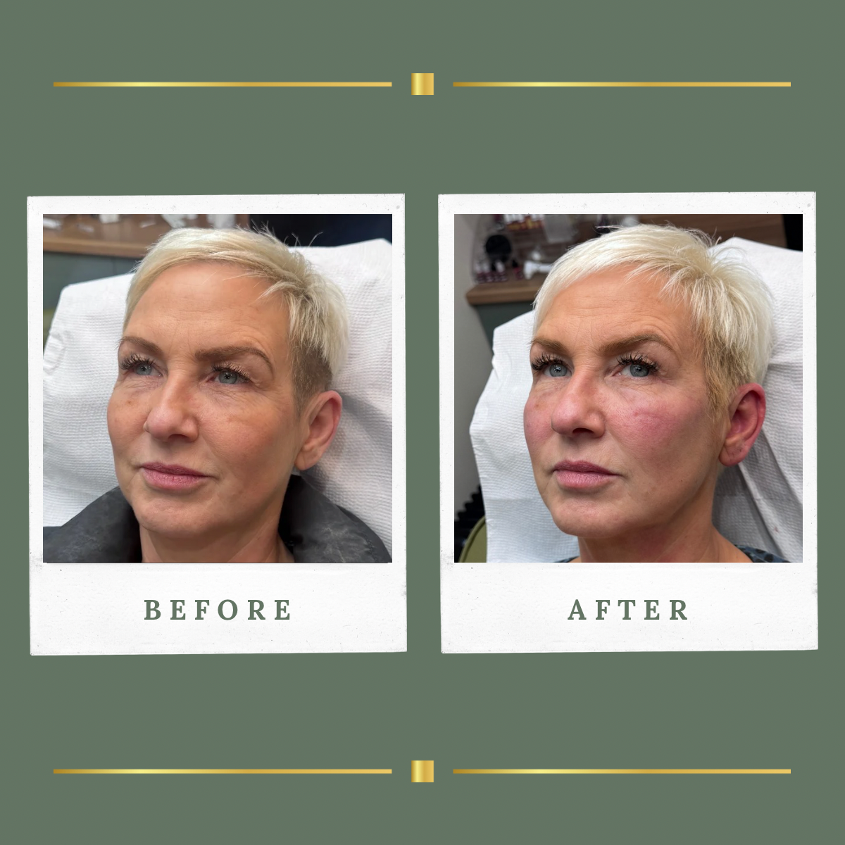 Cheek filler before and after result for a client from Mansfield