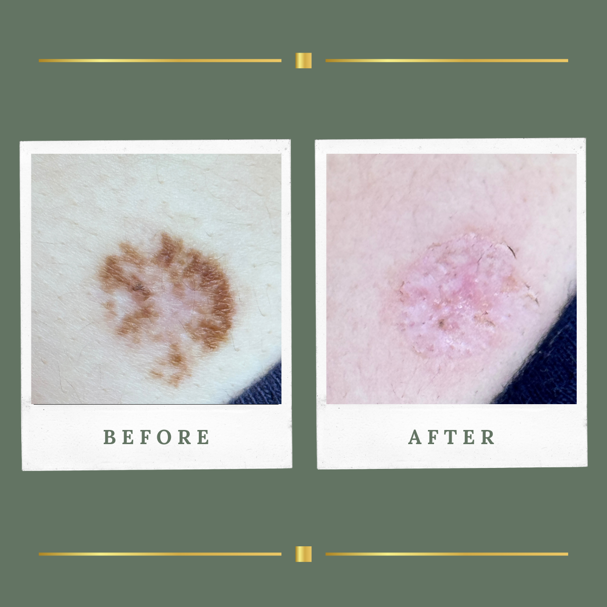 Before and after plasma mole removal result for a client from Nottingham