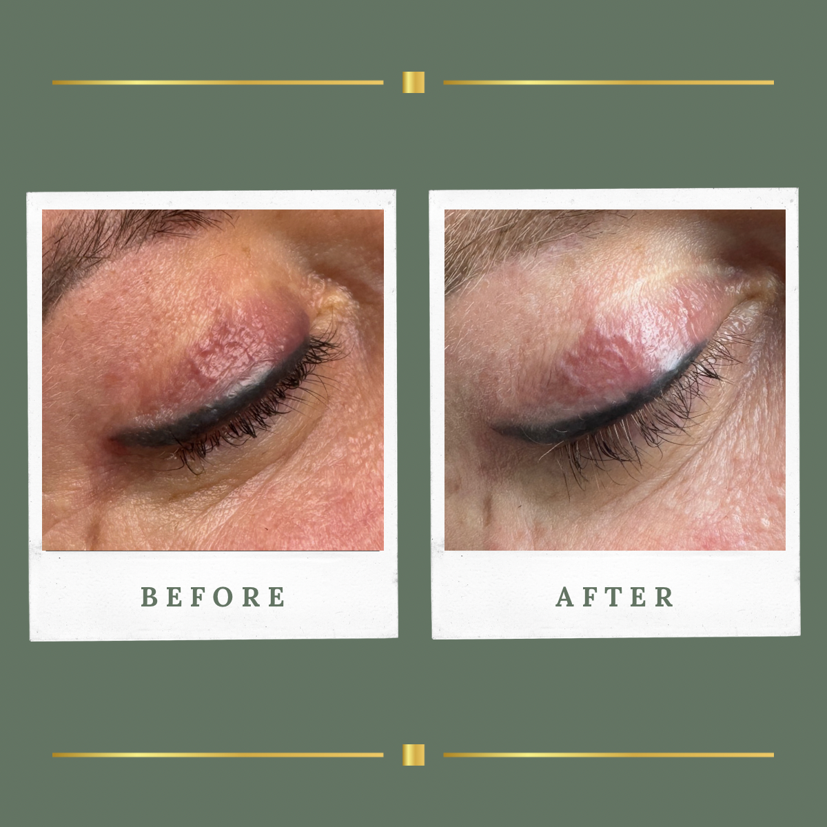 Eyeliner tattoo removal before and after result for a client from Nottingham