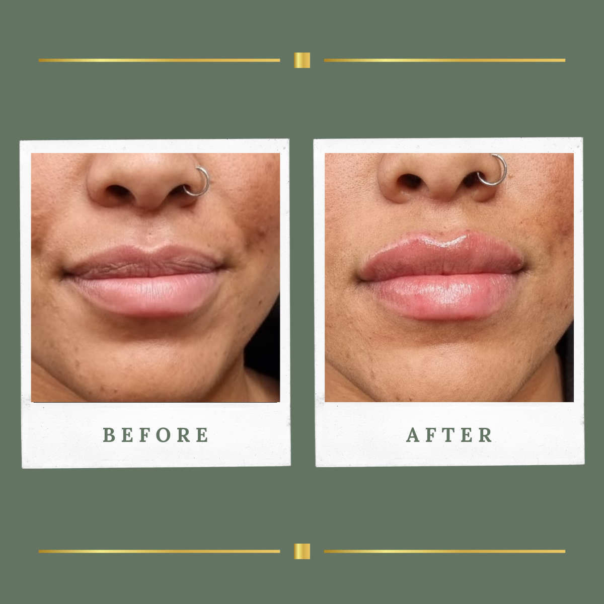 Natural lip filler before and after treatment at Rachel Aesthetics
