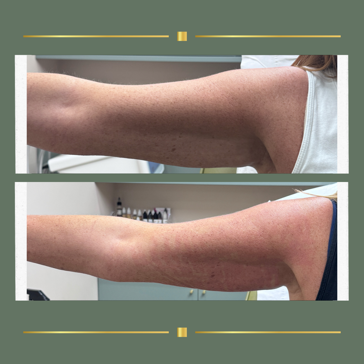 Upper arm before and after HIFU body tightening result