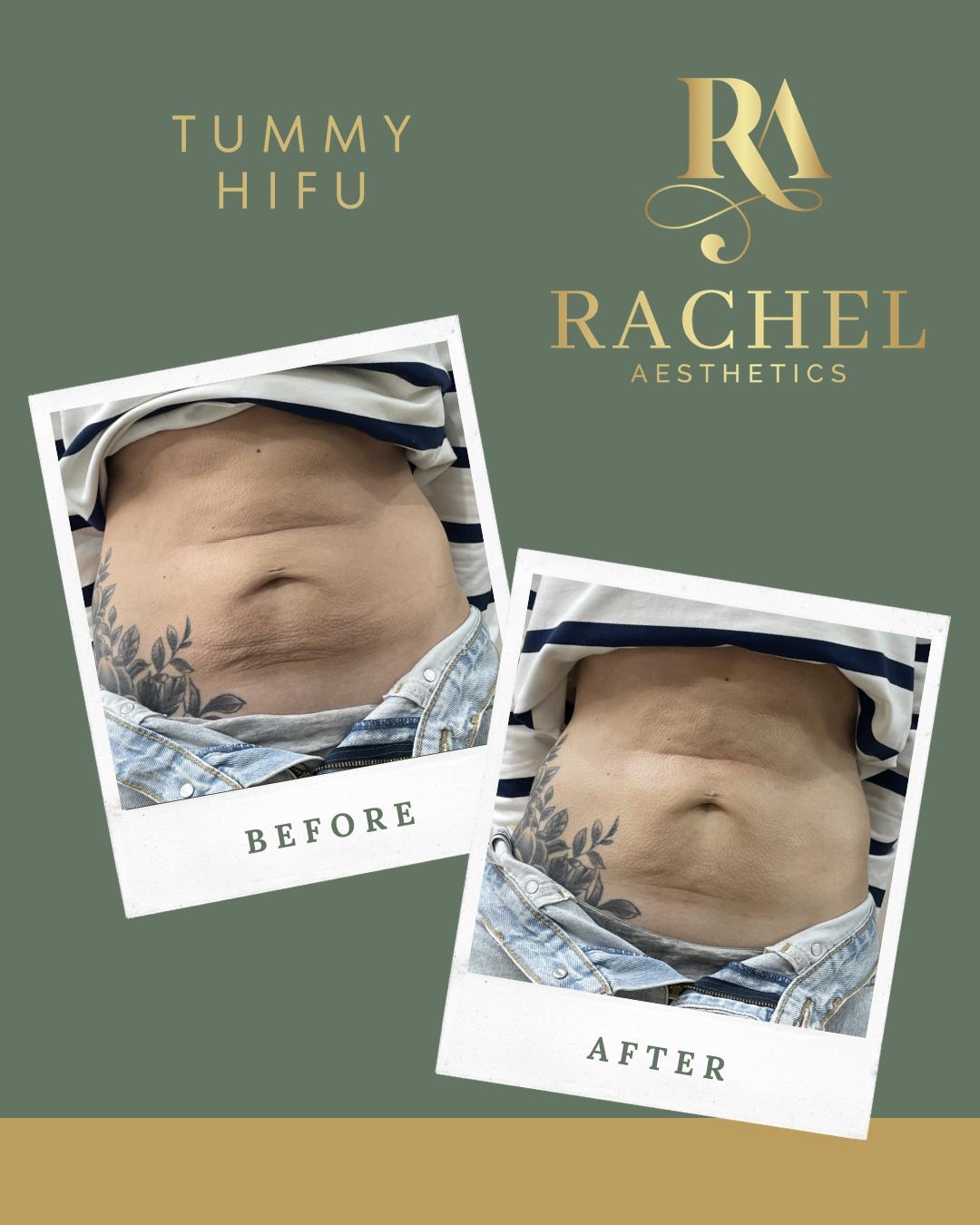 Tummy HIFU body sculpting before and after result at Rachel Aesthetics