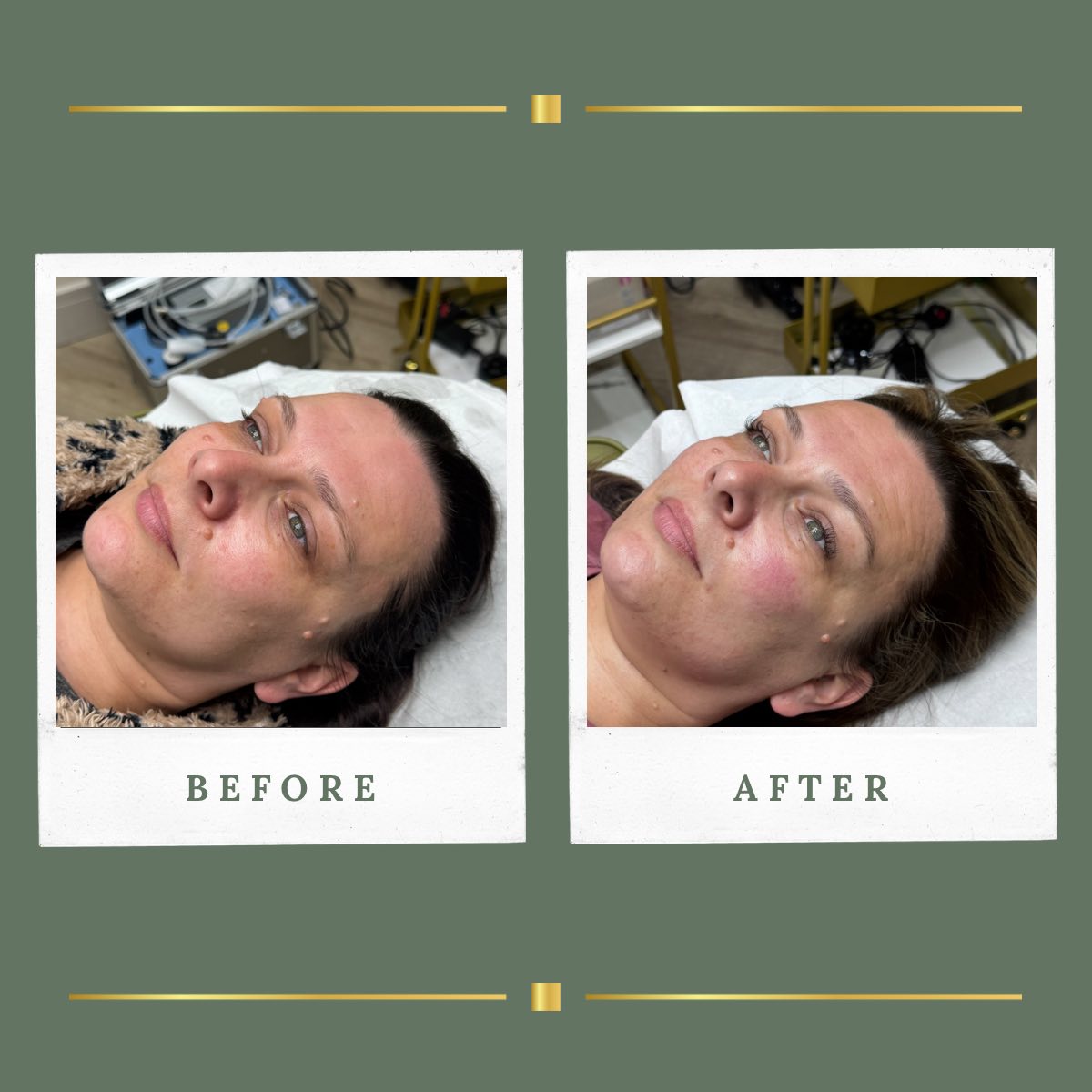 Advanced Korean facial skin result at Rachel Aesthetics, Nottinghamshire