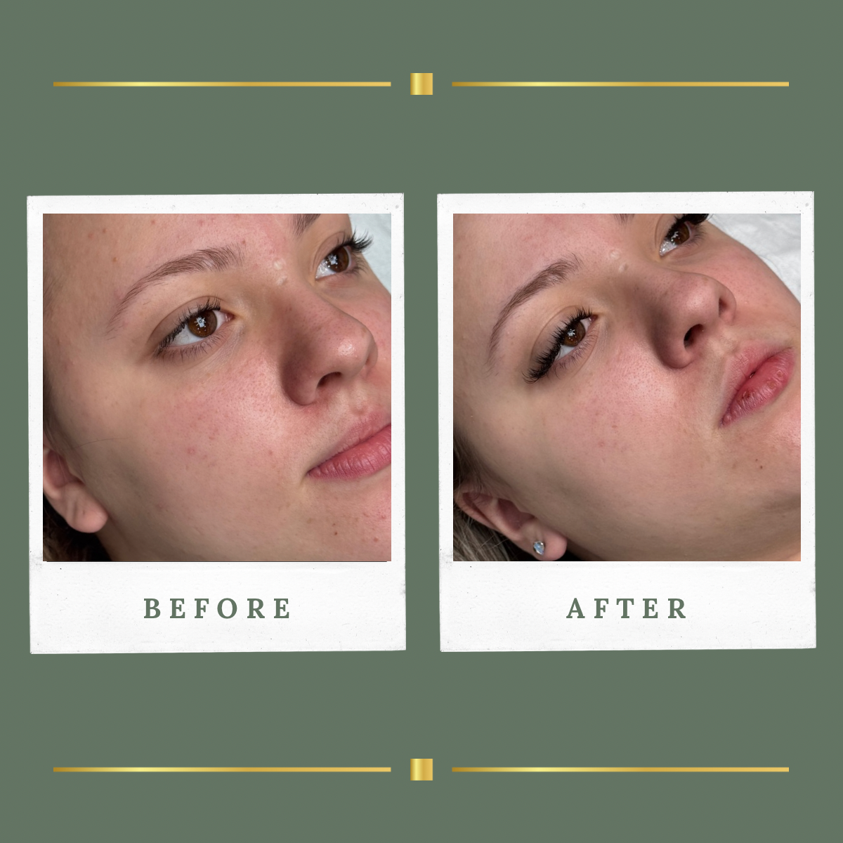 Acne peel before and after result at Rachel Aesthetics, Nottinghamshire