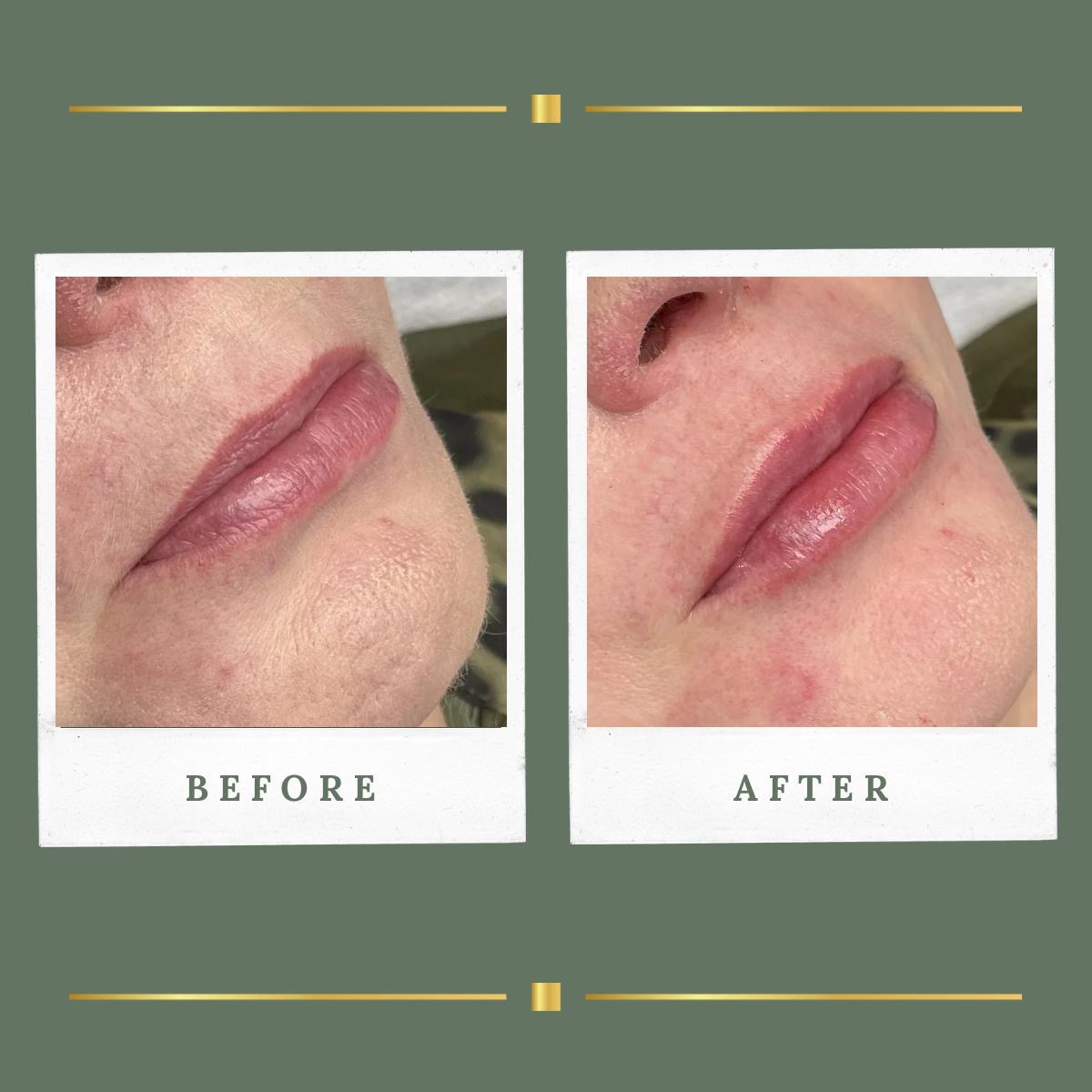 Natural lip filler before and after result for a client from Nottingham