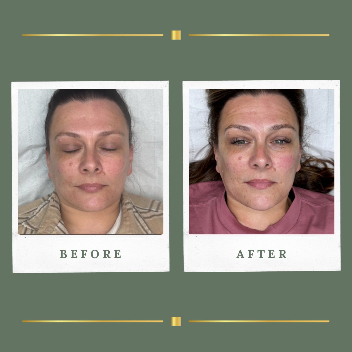 Skin transformation programme result at Rachel Aesthetics, Farnsfield