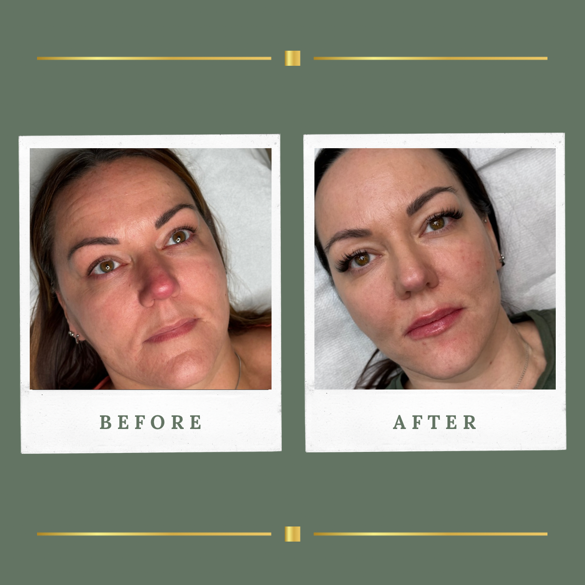Before and after facial skin transformation result at Rachel Aesthetics