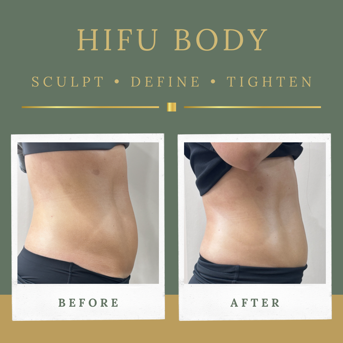 Side view before and after HIFU body tightening treatment