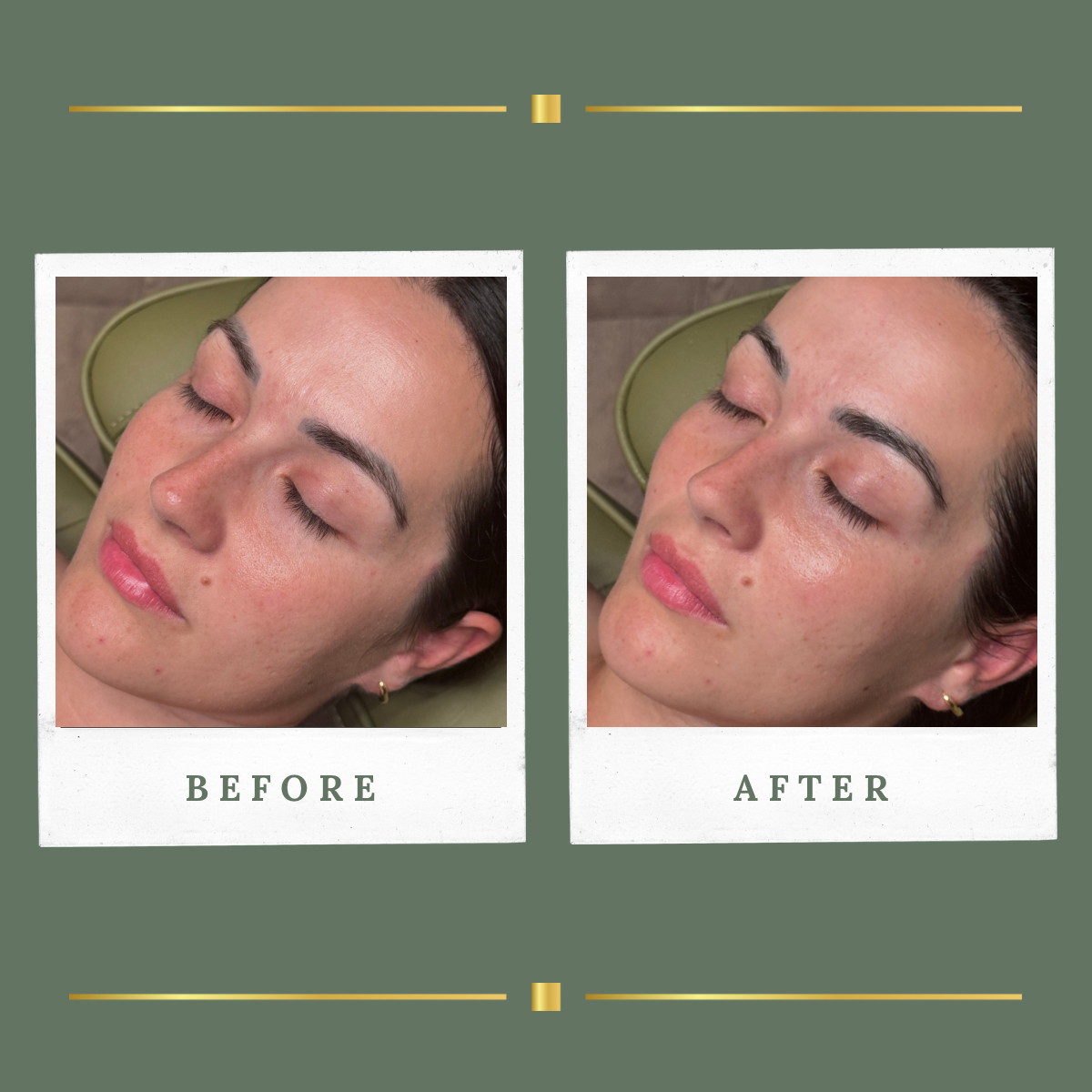 Before and after facial treatment result at Rachel Aesthetics in Farnsfield