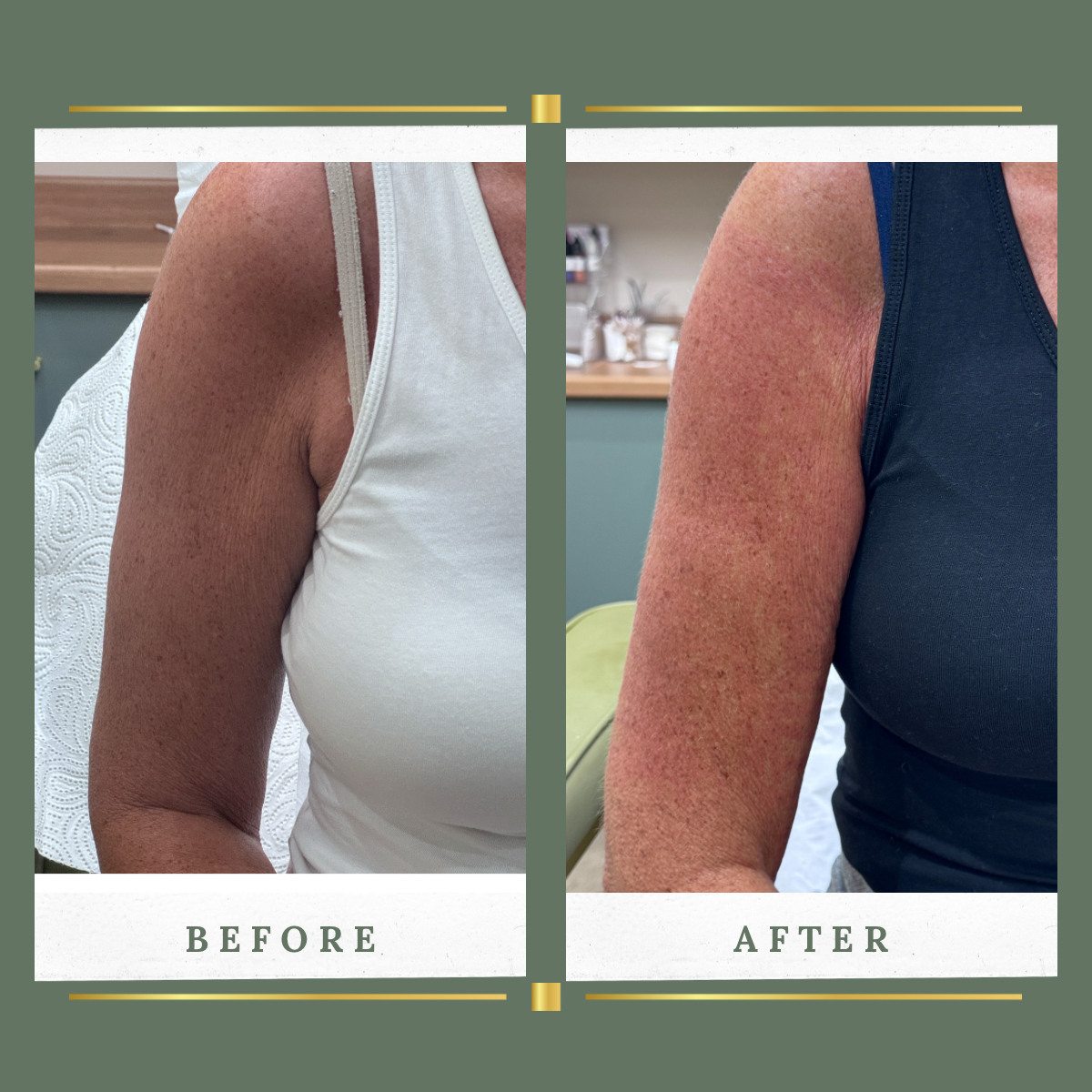 Upper arm HIFU body sculpting before and after result