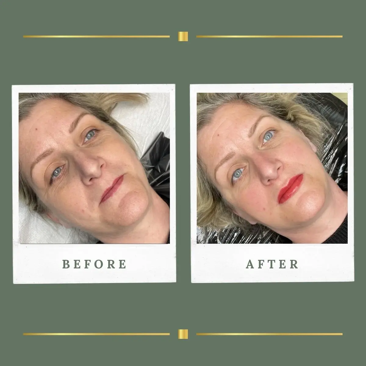 Permanent lip colour softening fine lip lines, Nottinghamshire