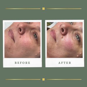 Facial Treatments Nottinghamshire | Rachel Aesthetics