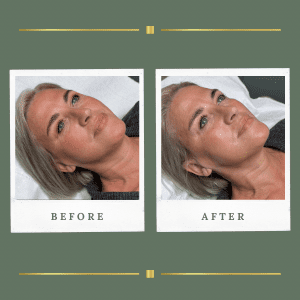 HIFU Skin Tightening. Jawline Tightening Nottinghamshire