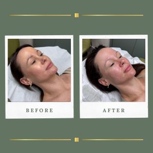 Skin Tightening Nottinghamshire