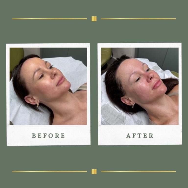 Skin Tightening Nottinghamshire