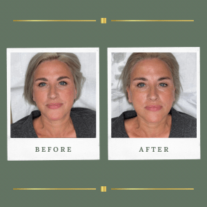 HIFU Nottinghamshire Gallery