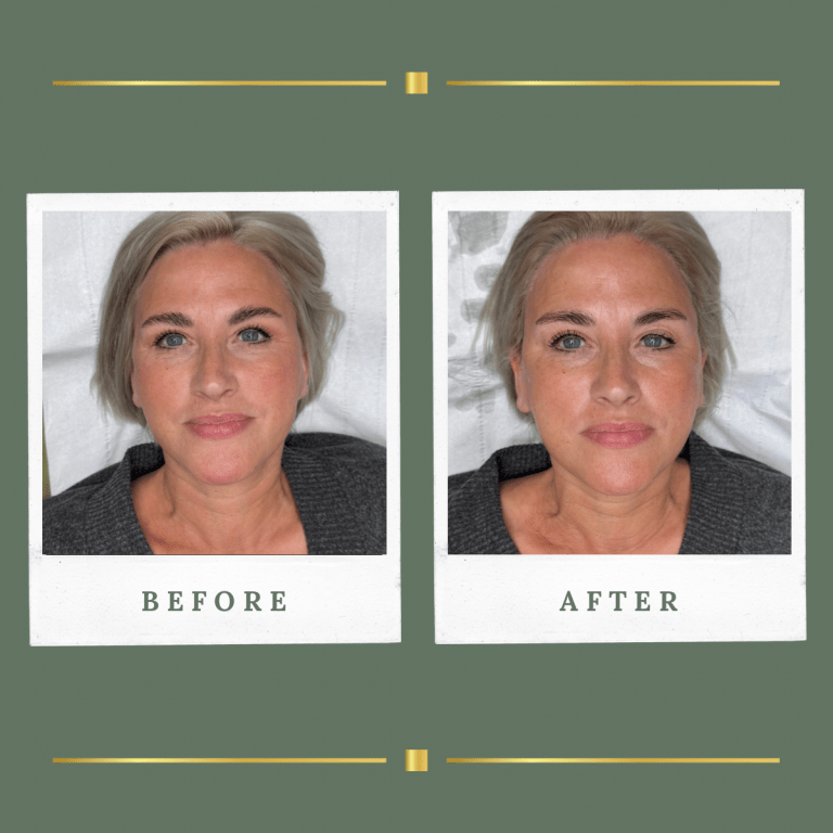 HIFU Nottinghamshire Gallery