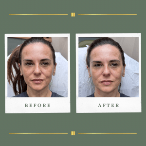 High Intensity Focused Ultrasound Southwell