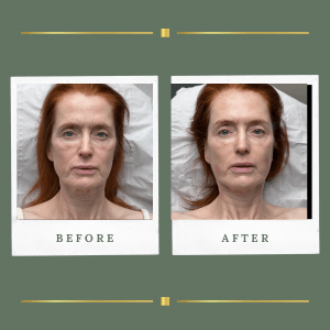 HIFU FaceLift Nottinghamshire